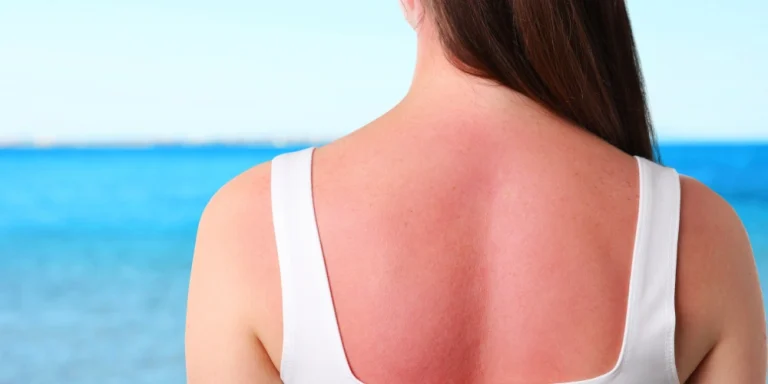 What are the natural ways to treat sunburn quickly?