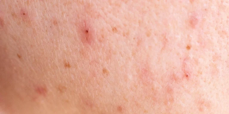 What are the natural ways to treat acne-prone skin?